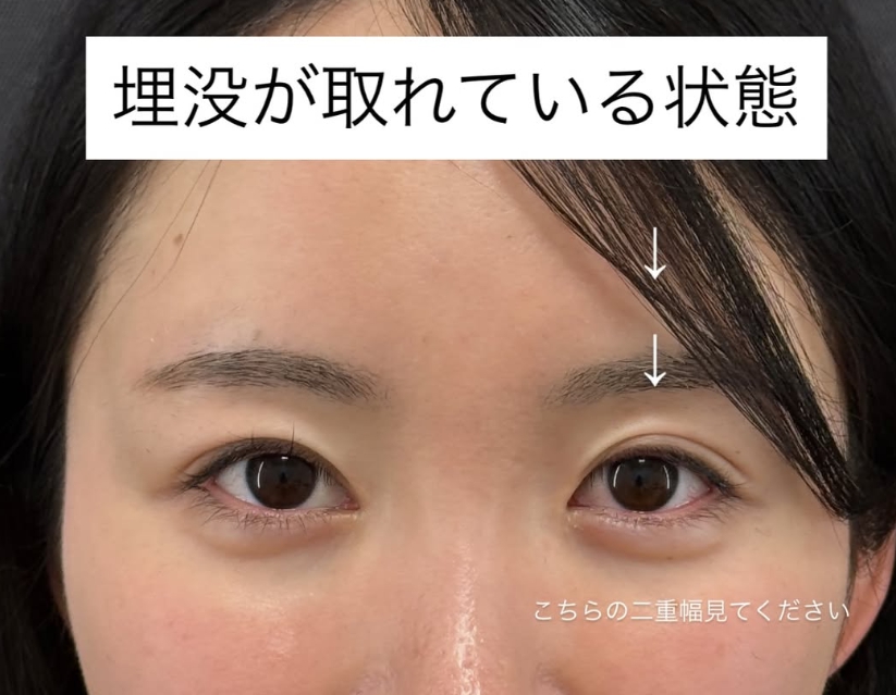 名古屋 二重埋没法の修正・やり直し症例