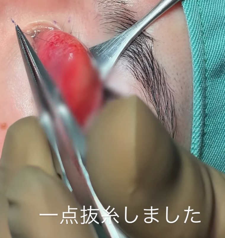 埋没糸の抜去と二重埋没法の修正