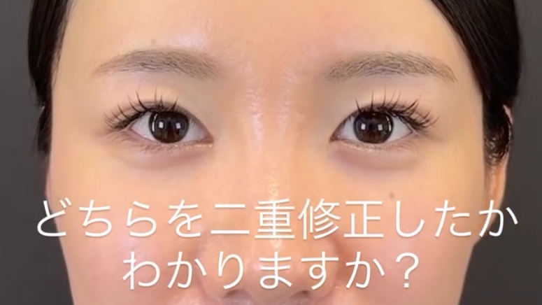 二重埋没修正のカウンセリングと施術の流れ