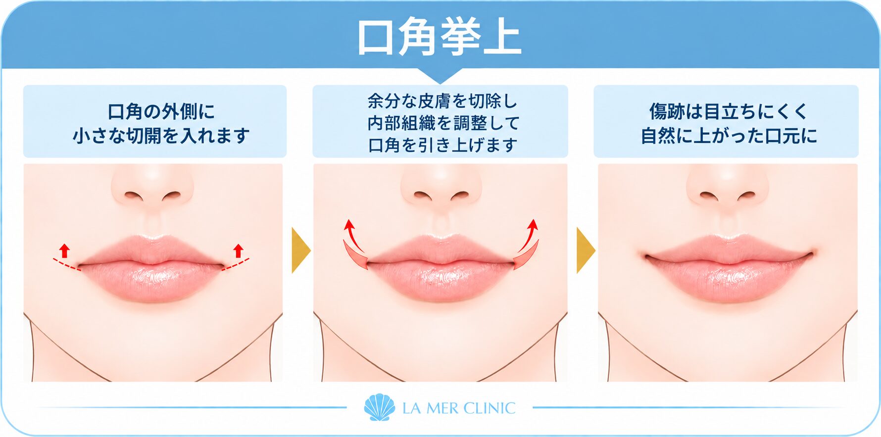口角挙上の施術イメージ
