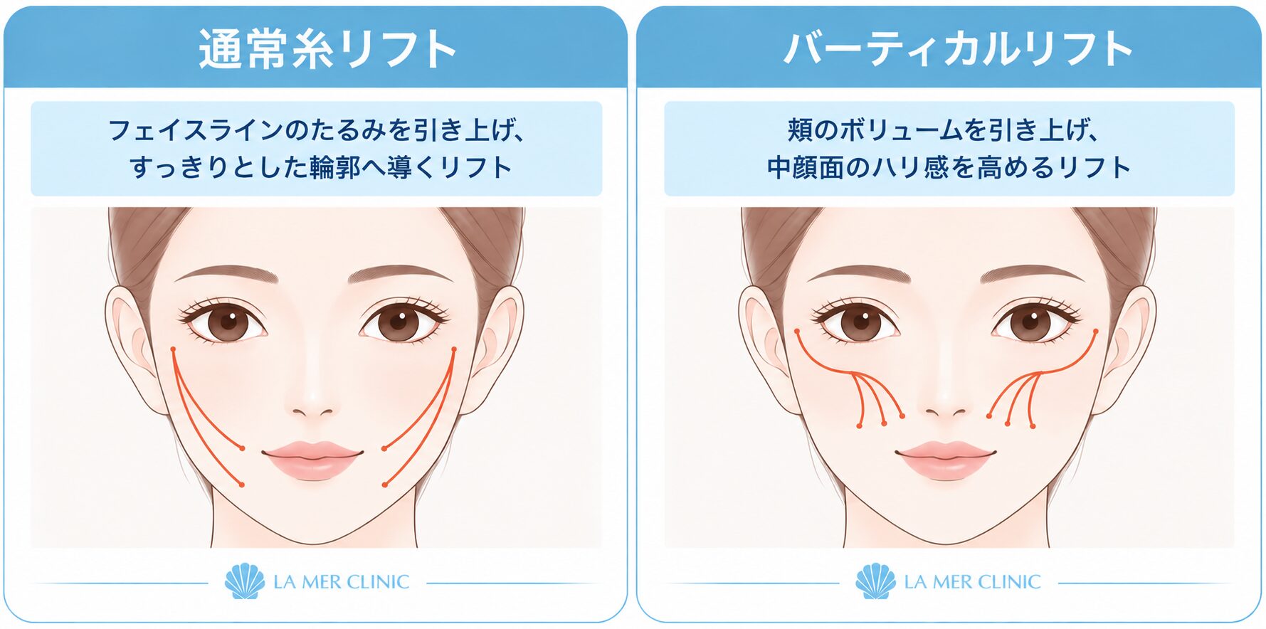 通常の糸リフトとバーティカルリフトの違いを比較した画像