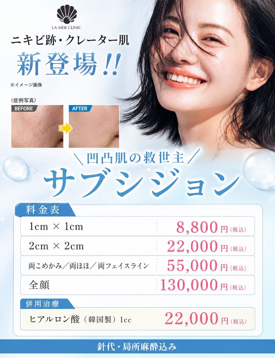 サブシジョンとは？ニキビ跡・クレーター治療の仕組み