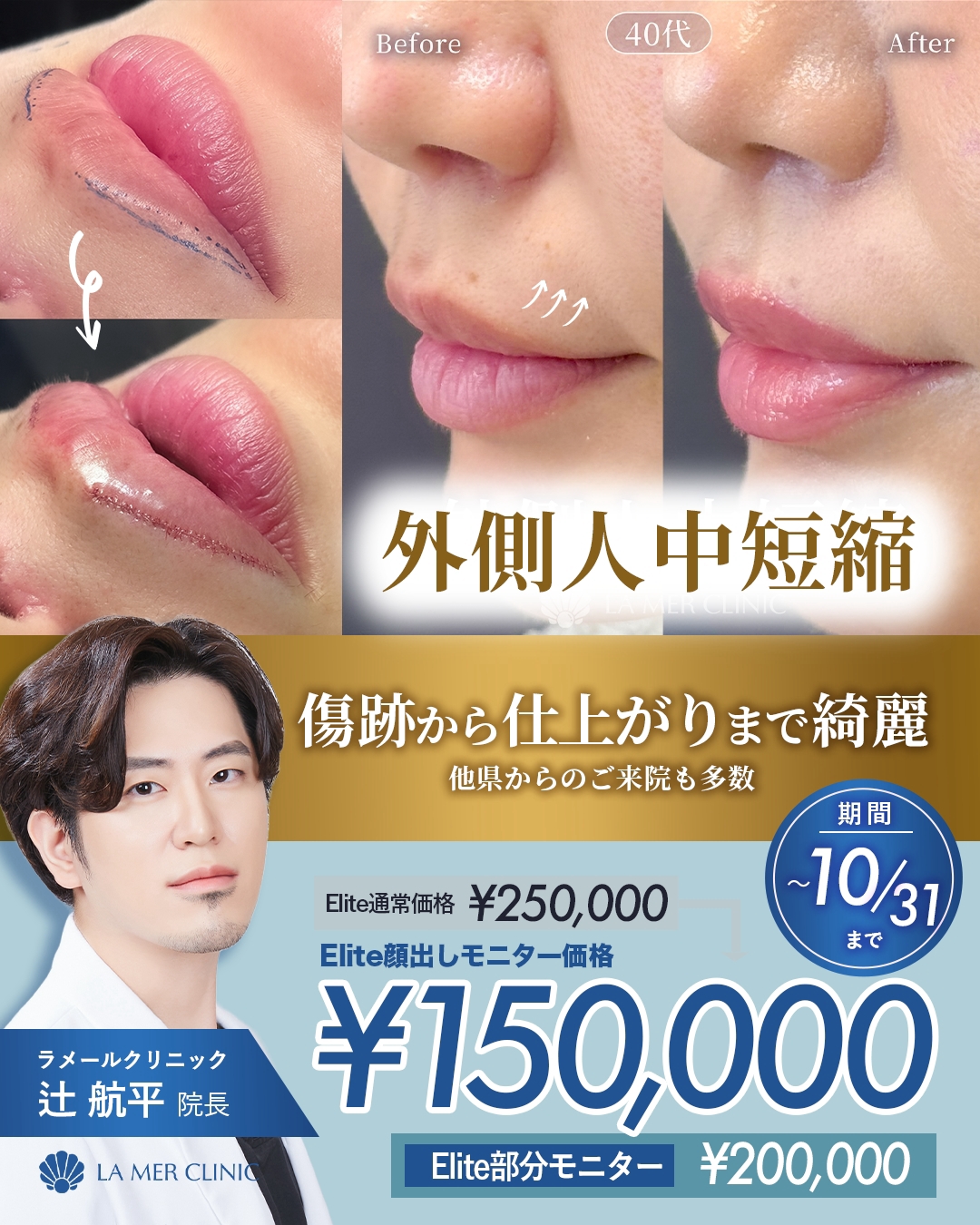 【名古屋】人中短縮・外側人中短縮・口角挙上が安い！