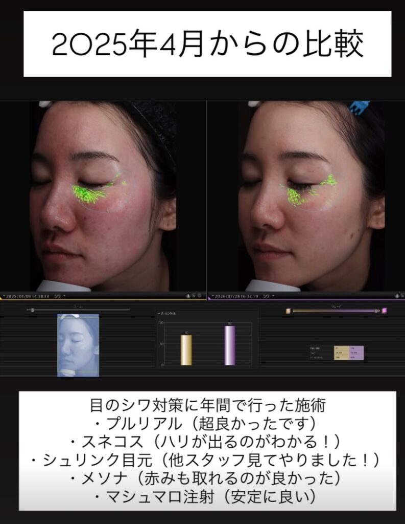 スタッフおすすめの美肌施術 ダブルピコとメソナJ