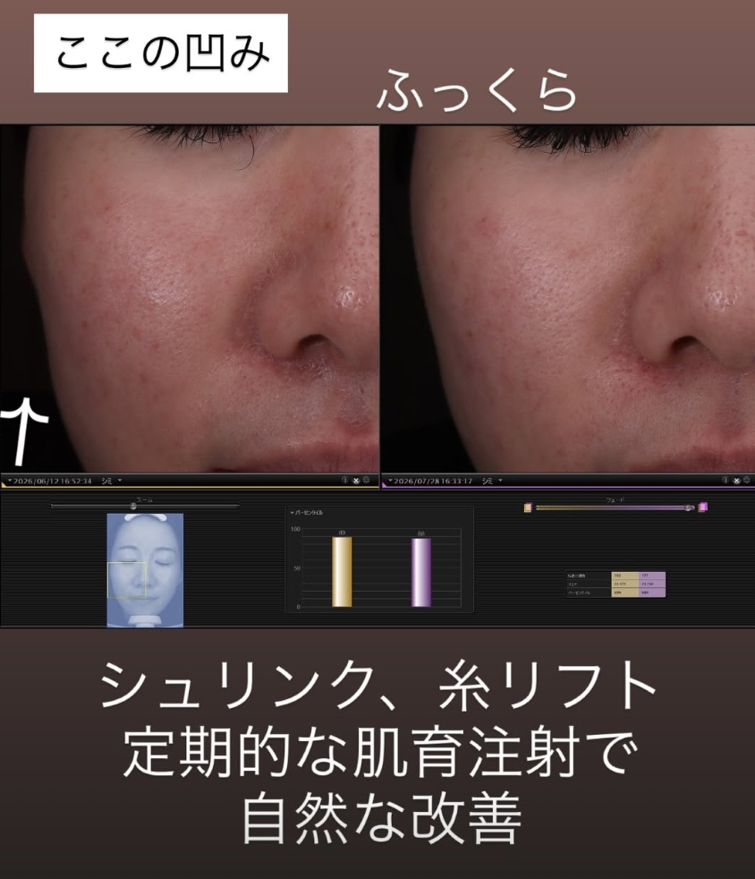 ダブルピコの施術紹介