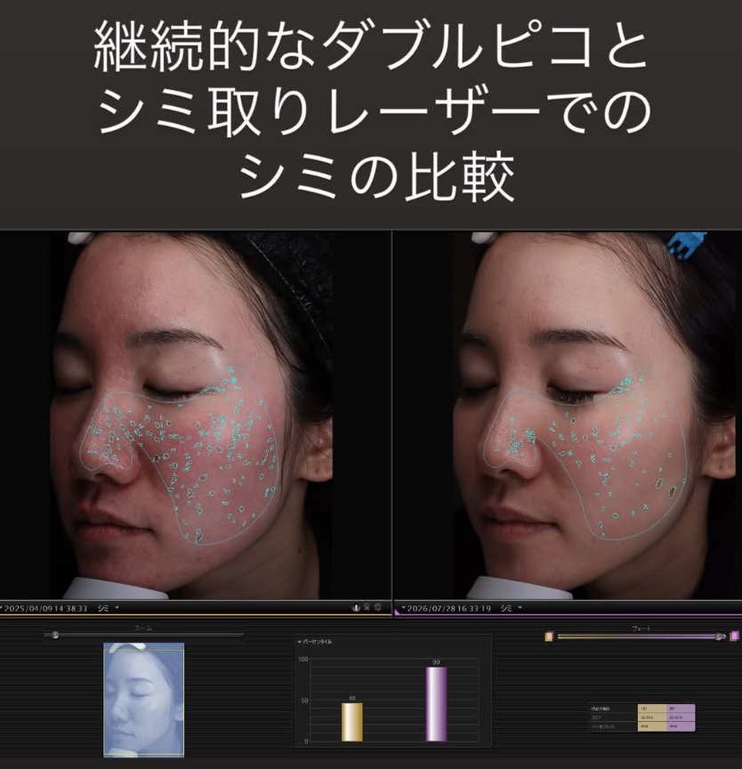 ダブルピコとメソナJの組み合わせ治療
