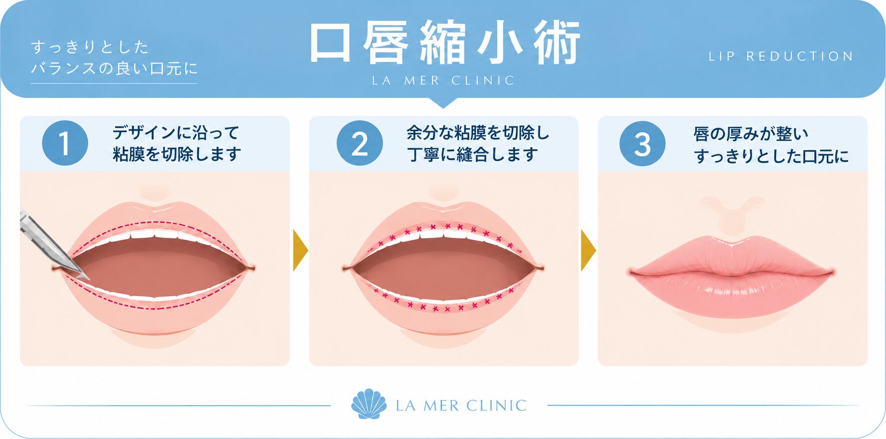口唇縮小術の施術方法