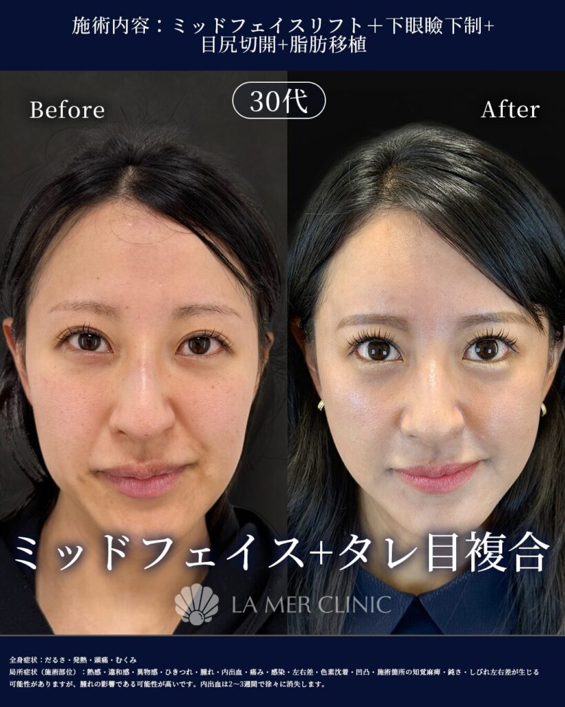 頬のボリュームに関する症例画像1