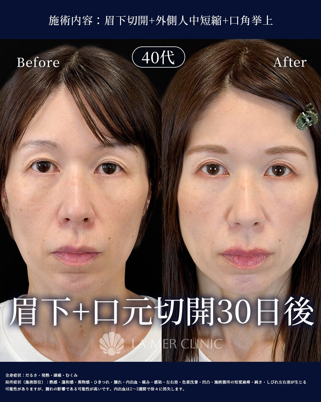 外側人中短縮 術後1か月