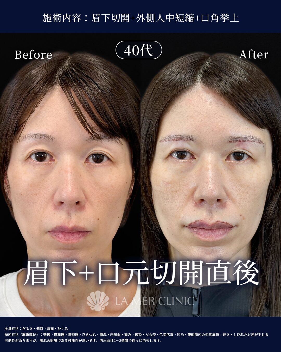 外側人中短縮 手術直後の傷跡