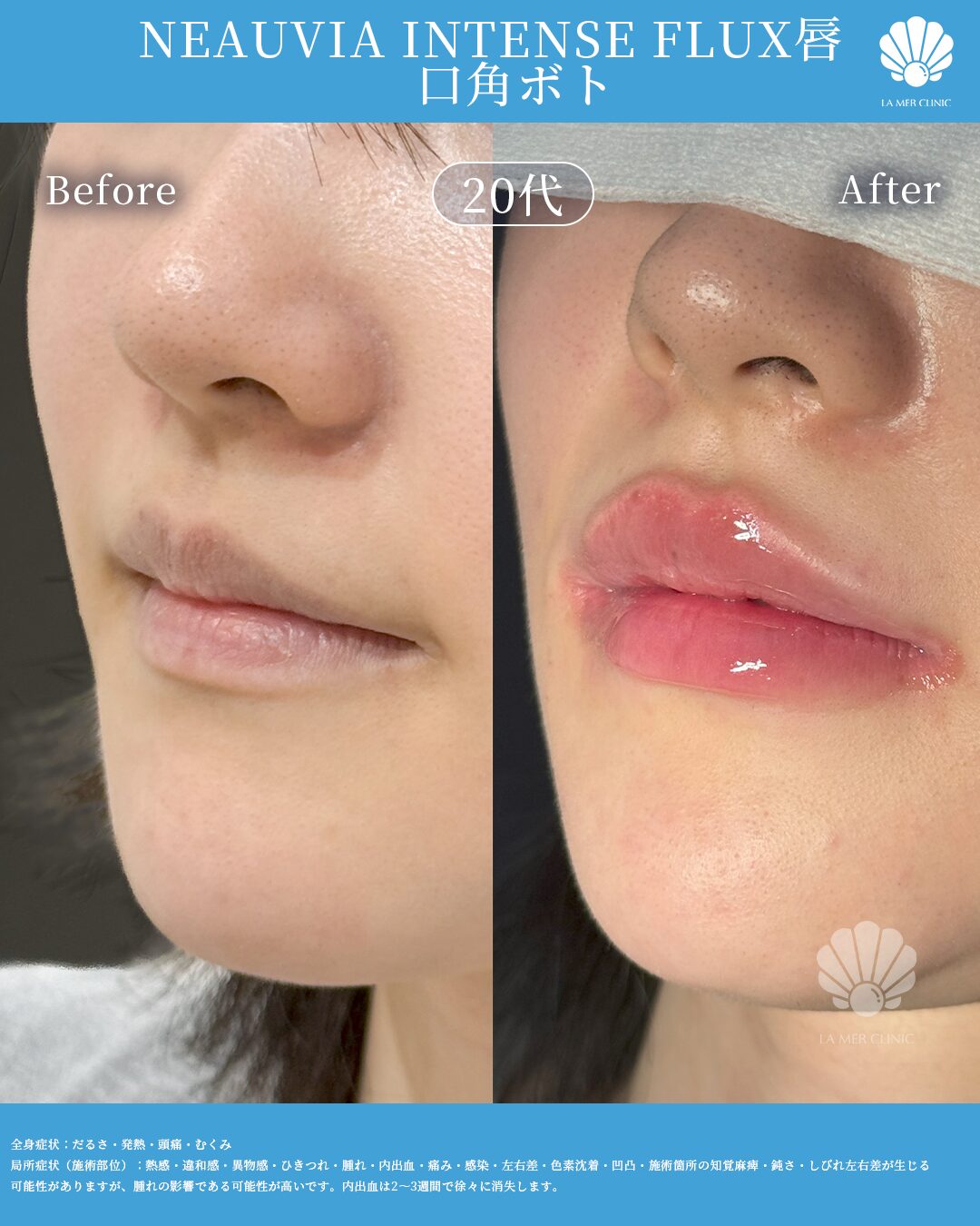 LA MER CLINIC 唇ヒアルロン酸症例