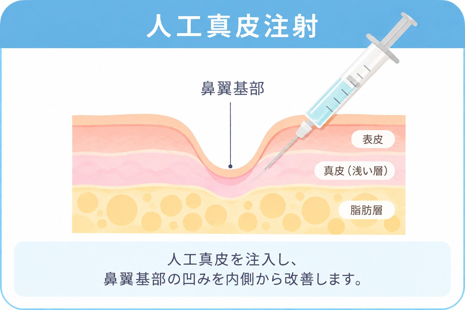 人工真皮注射によるほうれい線治療の仕組み
