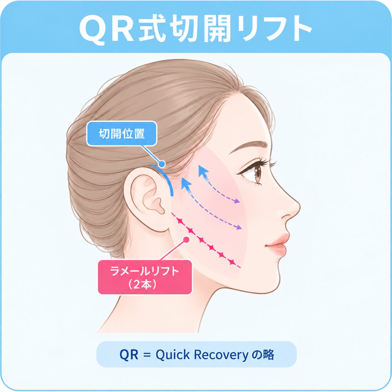 QR式切開リフトの施術方法