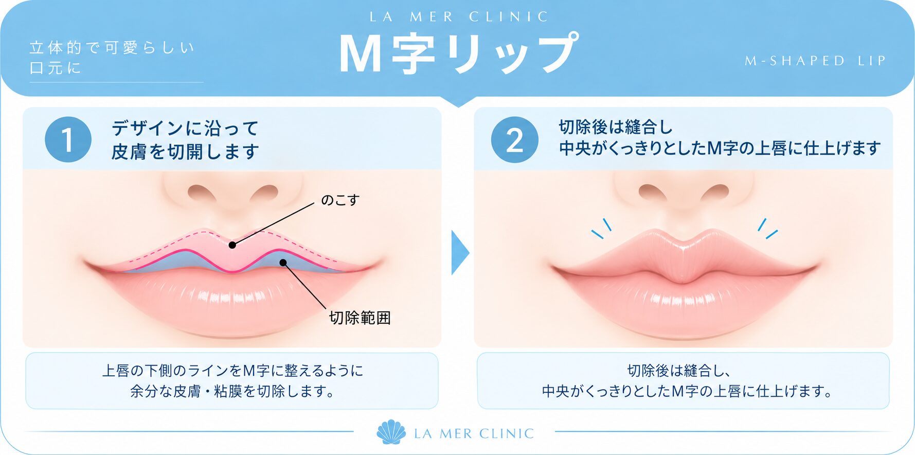 M字リップ形成の施術方法