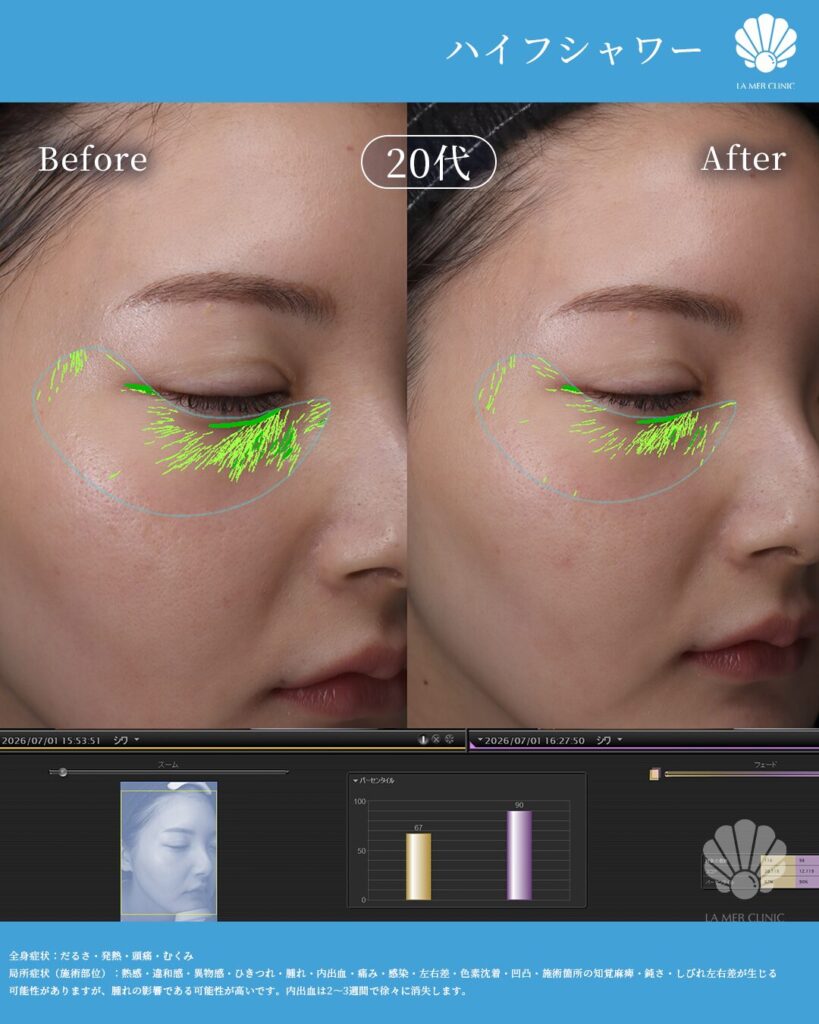 よっぴの美容医療体験写真2