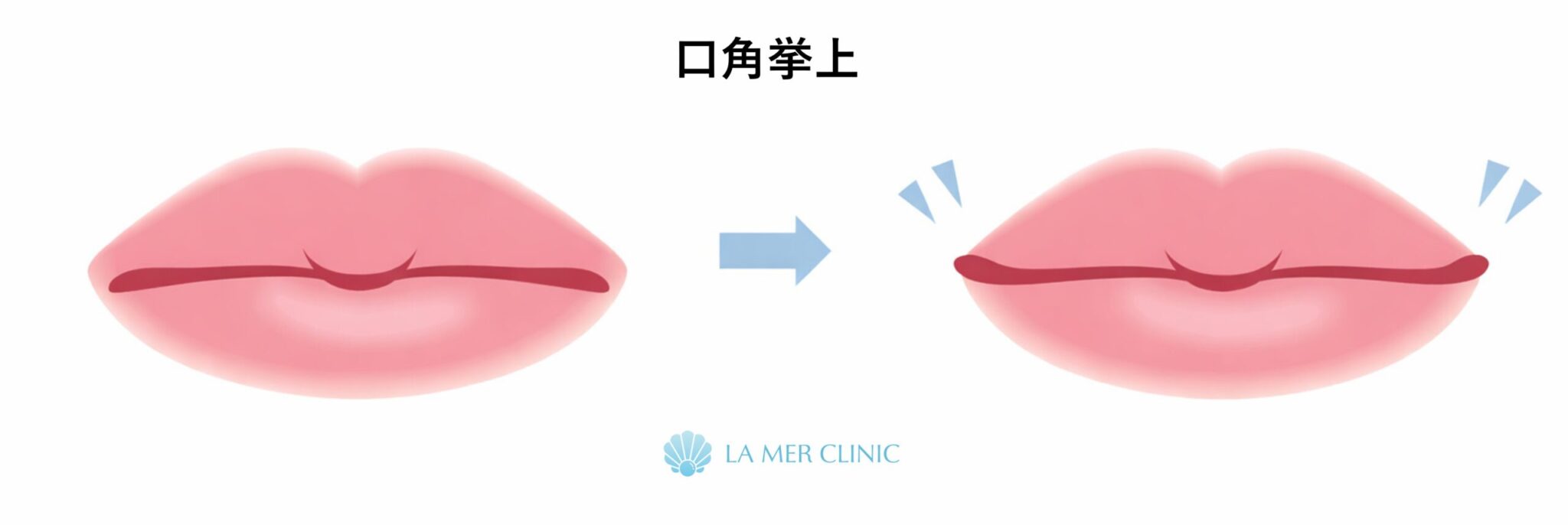 口角挙上とは