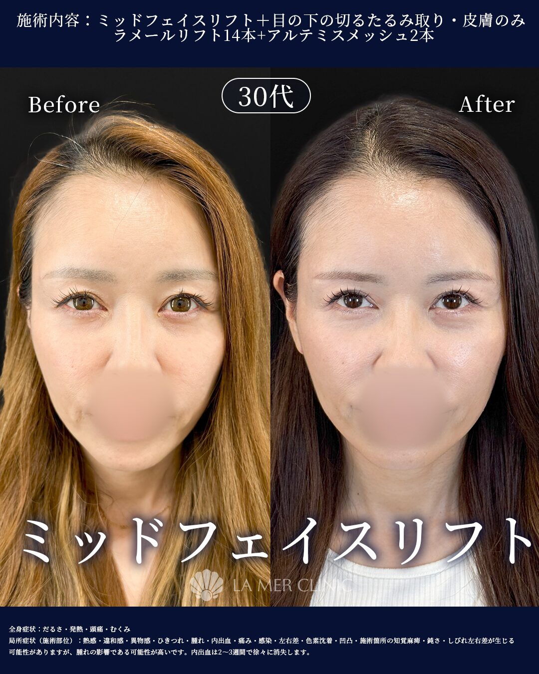 目の下のたるみ取り 症例写真2