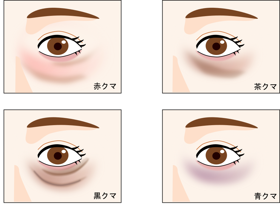 目の下のたるみができる原因の解説