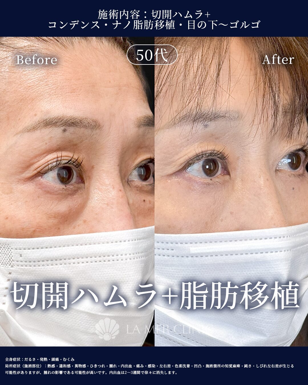 目の下のたるみ取り 症例写真1