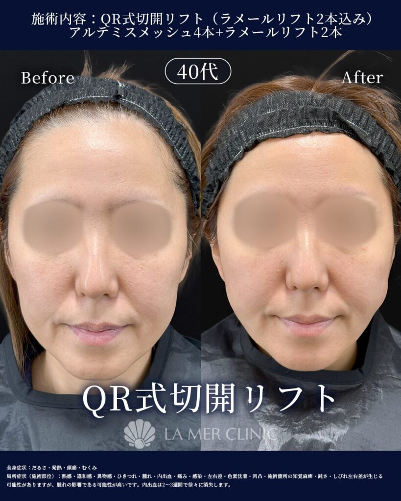 QR式切開リフト フェイスライン Before After