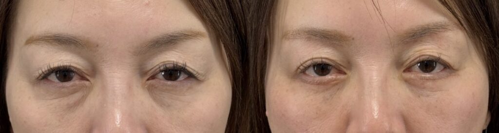 目の下のたるみ治療 Before After 目元の比較写真