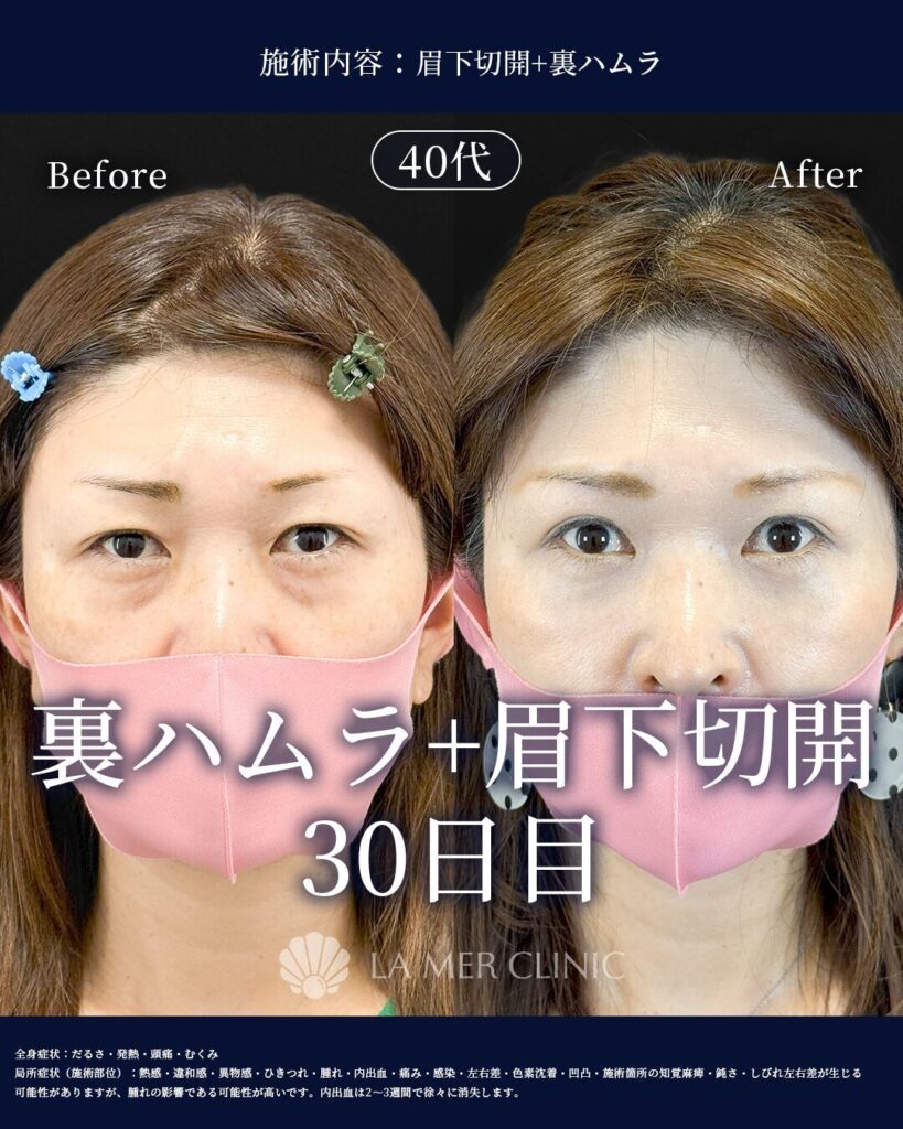 切らないクマ取り 10月限定キャンペーン