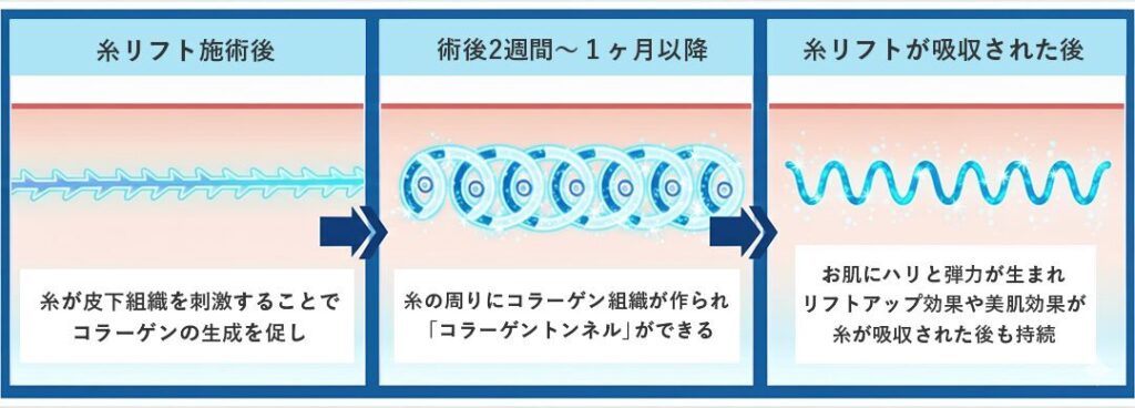 VOVリフトまたはアルテミスメッシュHARDを選べる糸リフト6本セット