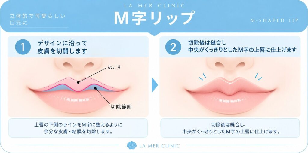 M字リップ形成のデザイン