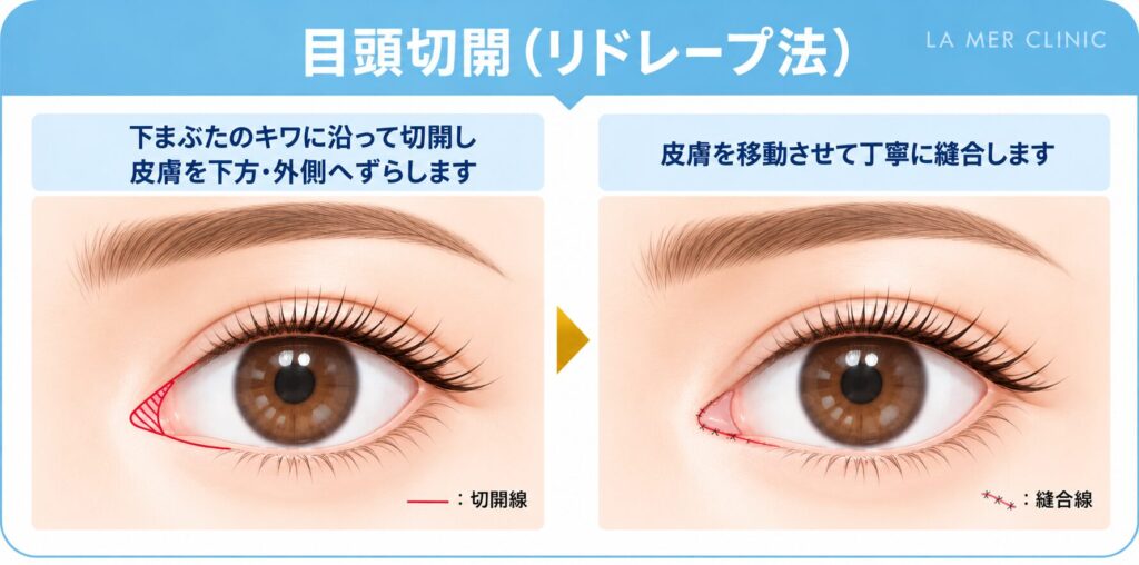 目頭切開 リドレープ法の説明図