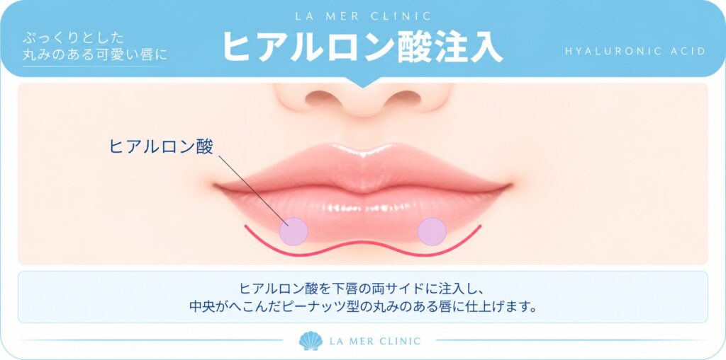 ヒアルロン酸によるピーナッツリップのデザイン