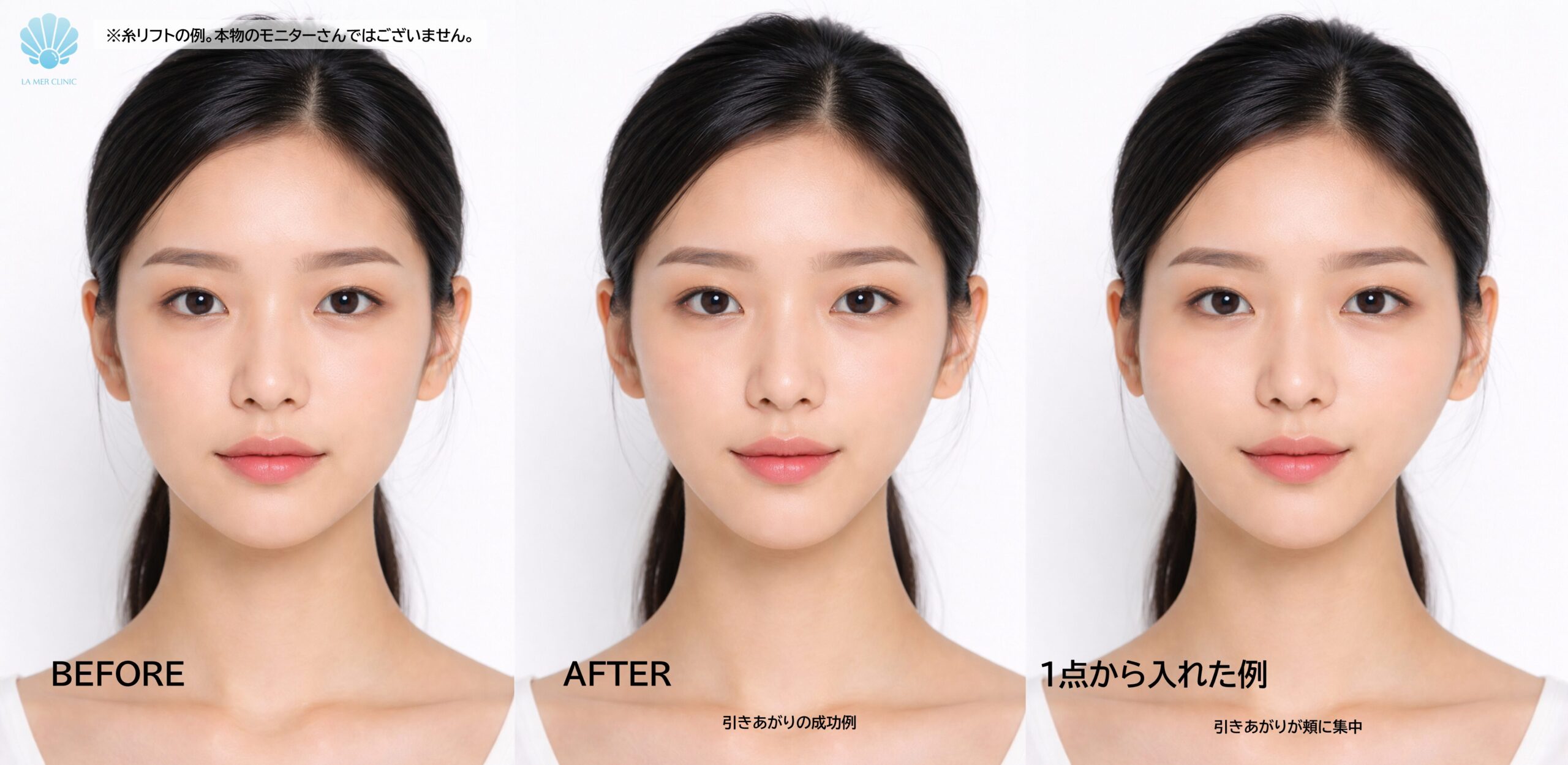 糸リフトの仕組みを説明した画像