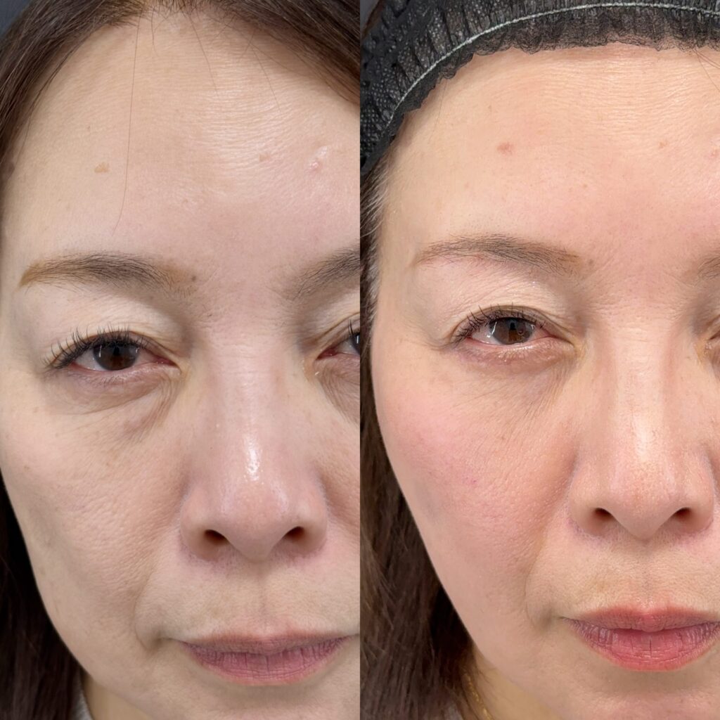 目の下のたるみ治療 Before After 顔全体の比較写真