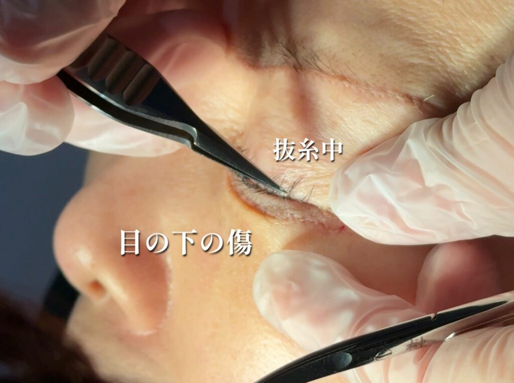 下眼瞼除皺術の抜糸中の様子と目の下の傷跡