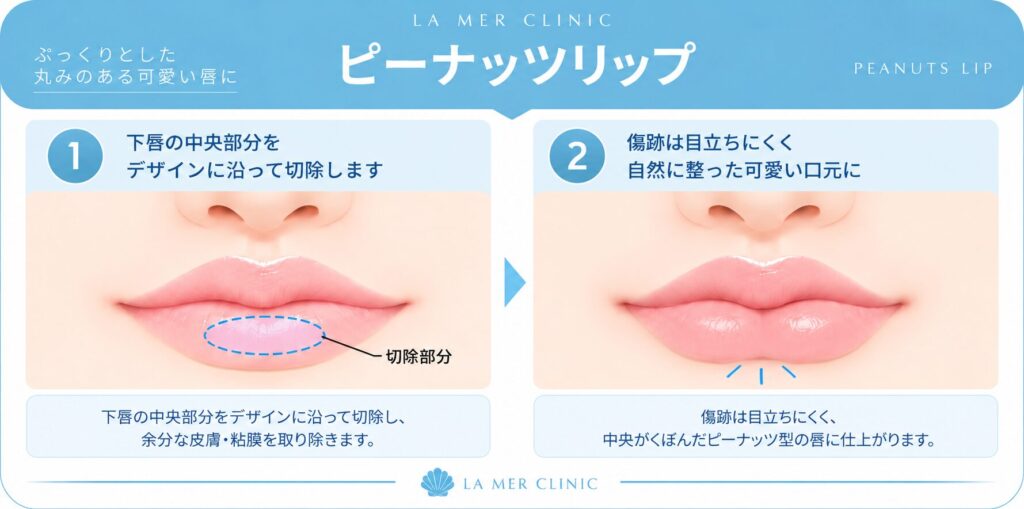 切開によるピーナッツリップ形成術の説明画像